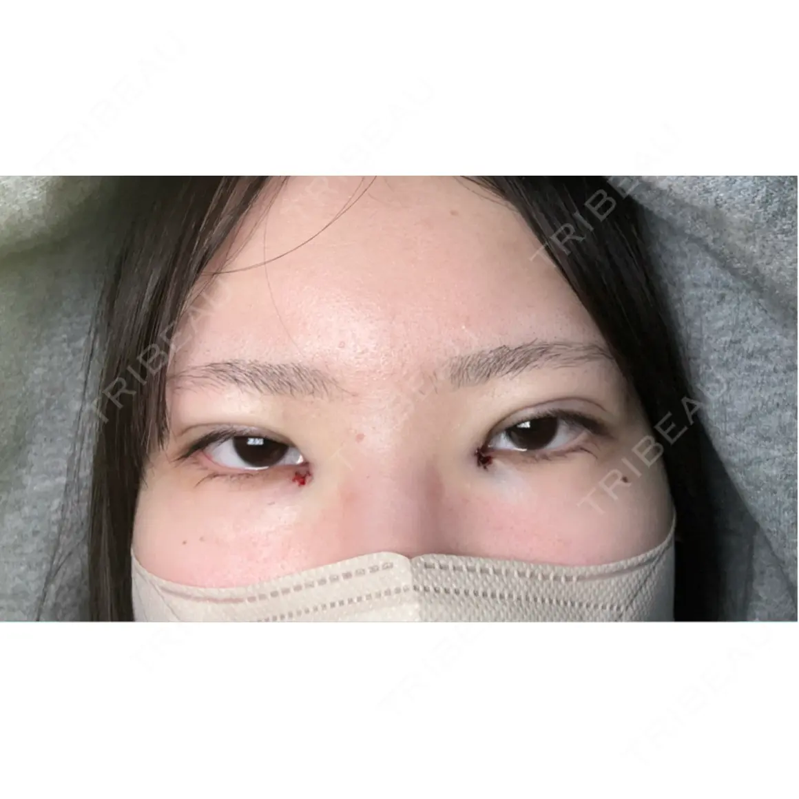 二重埋没 / 目頭切開 / 上まぶたの脂肪取り 9BeautyClinic DAY 0