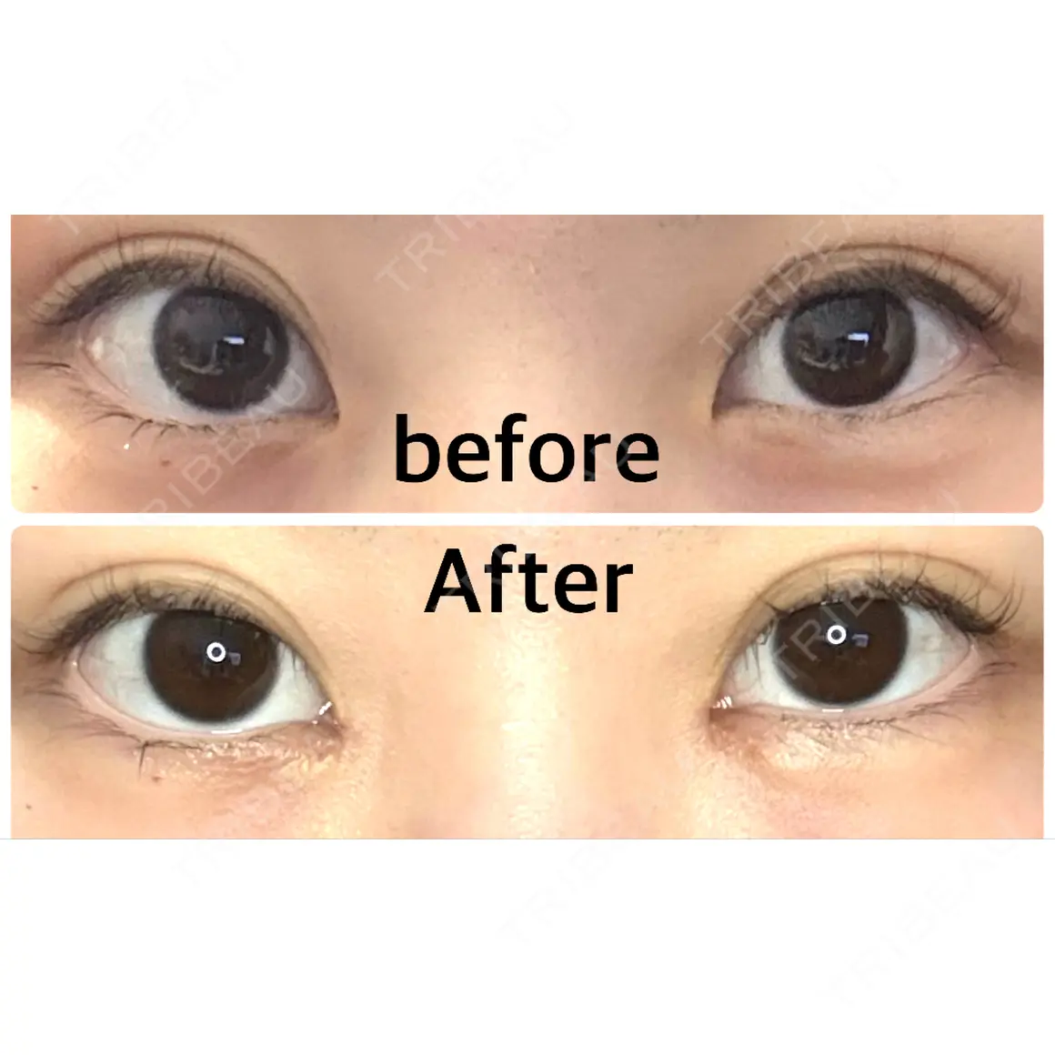 目頭切開 9BeautyClinic AFTER