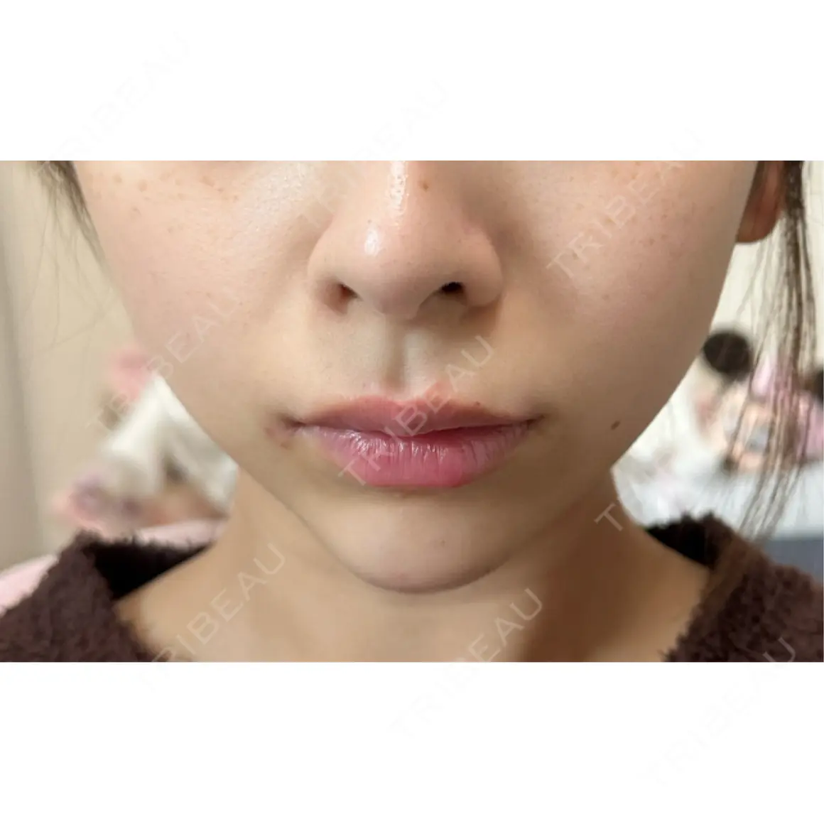 ボトックス（あご） / ヒアルロン酸注入（あご） HAAB×DREAM BEAUTY CLINIC 東京本院 DAY 0