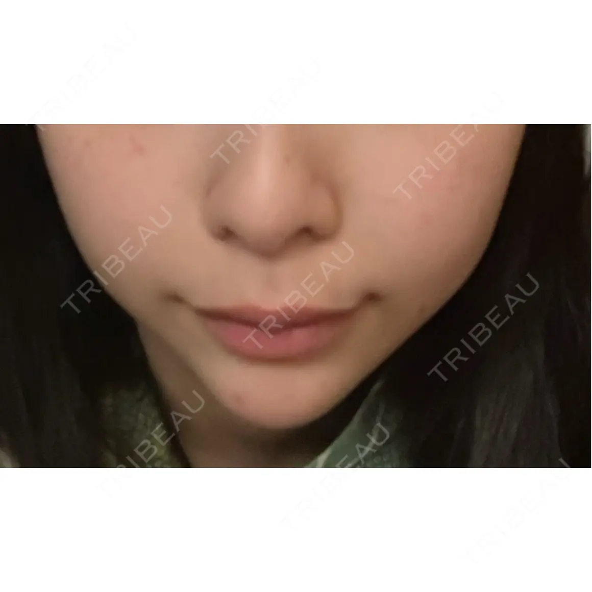 ボトックス（あご） / ヒアルロン酸注入（あご） HAAB×DREAM BEAUTY CLINIC 東京本院 AFTER