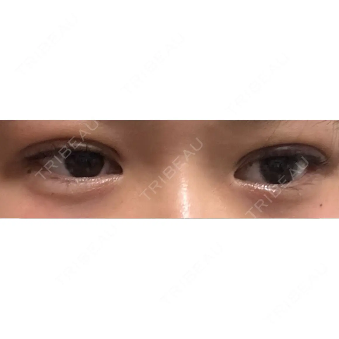 二重埋没 9BeautyClinic DAY 0