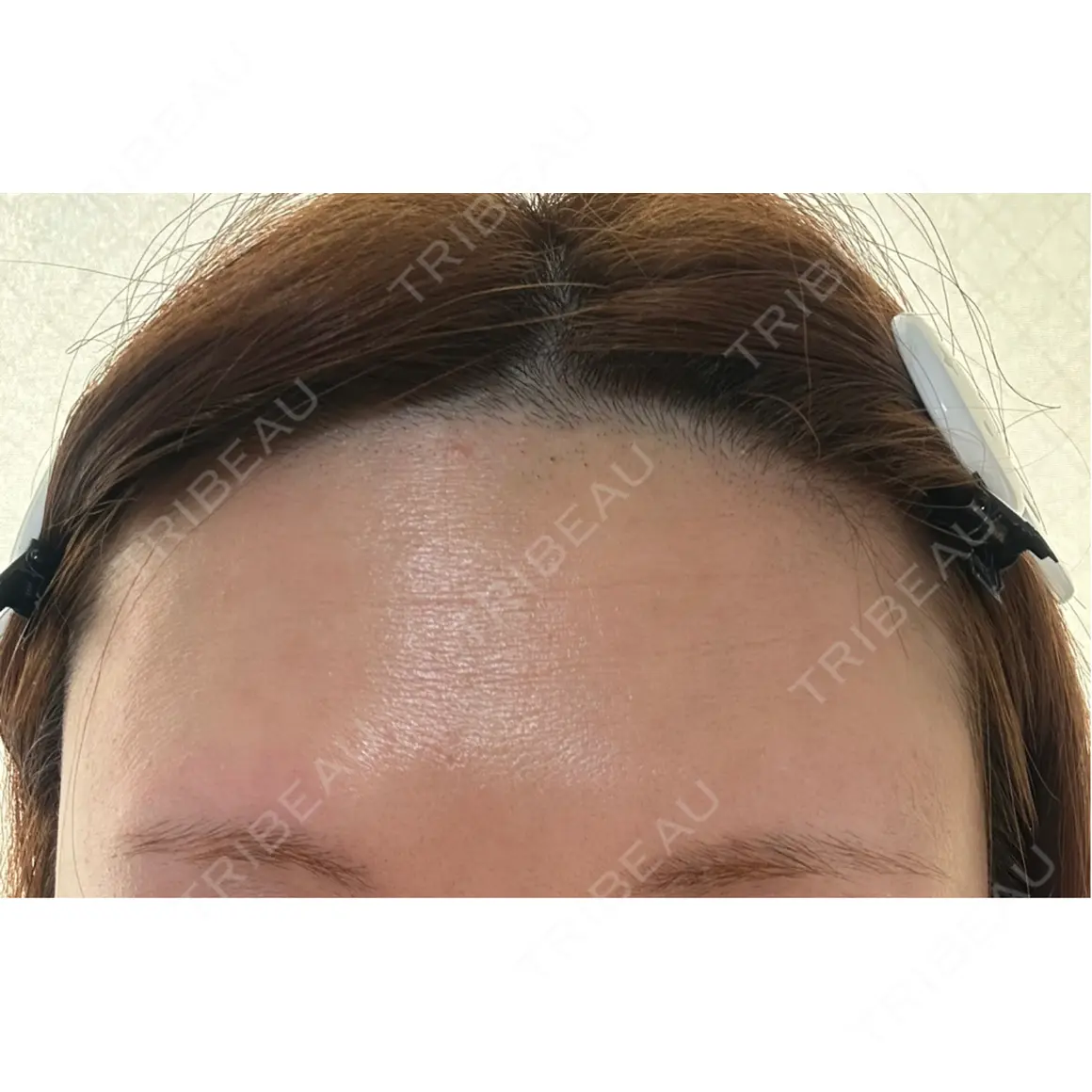 医療脱毛（顔） Jスキンクリニック 【J-SKIN clinic】 AFTER