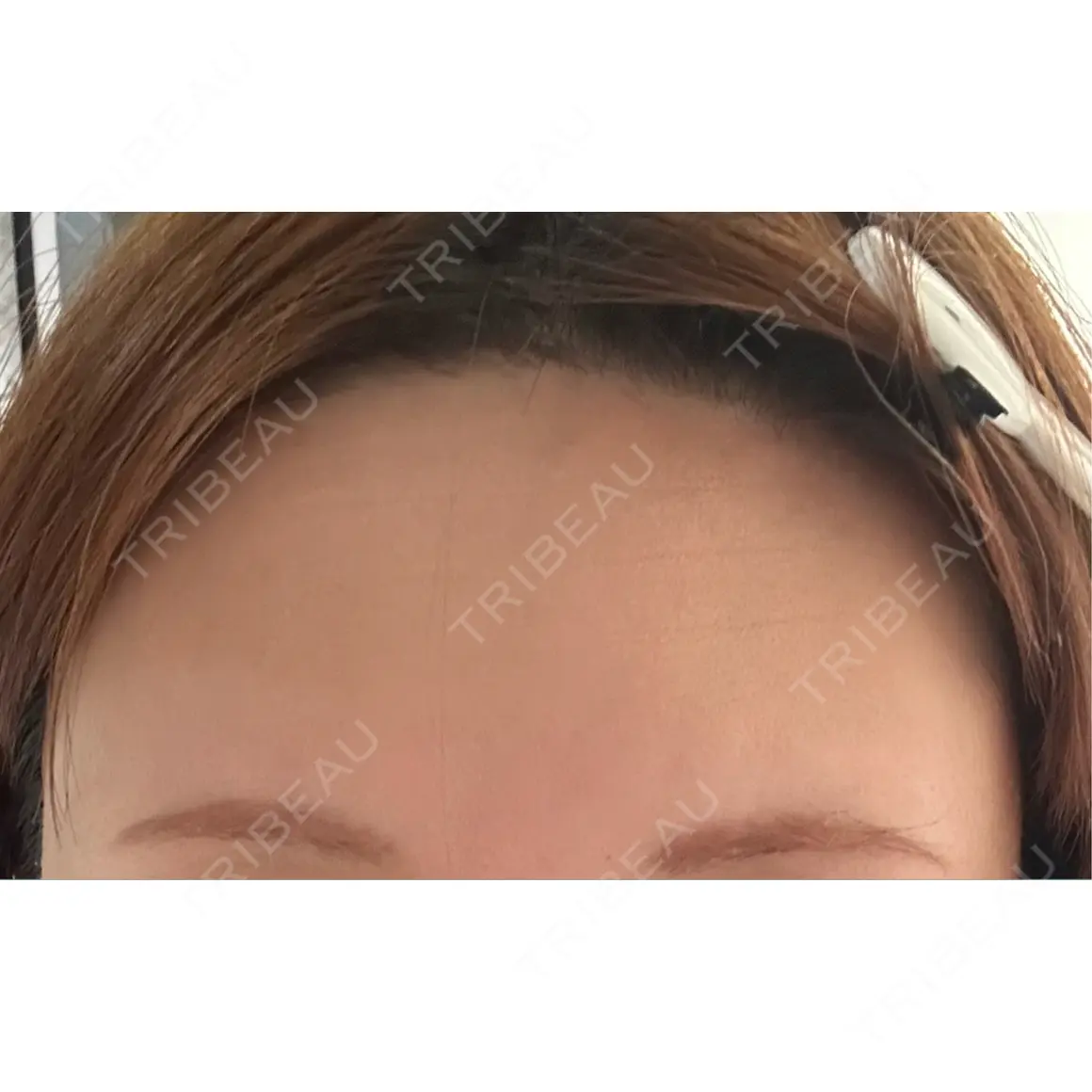 医療脱毛（顔） Jスキンクリニック 【J-SKIN clinic】 AFTER