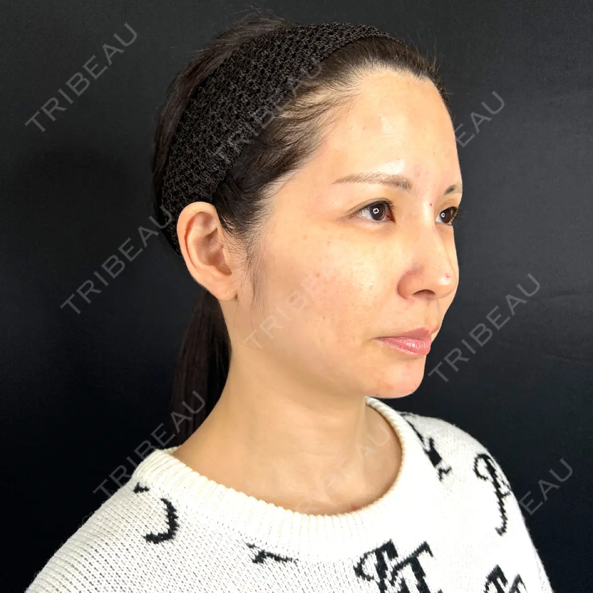 ボトックス（あご） / ヒアルロン酸注入（あご） / ボトックス（口角） / ボトックス（眉間） / ボトックス（目尻） / ボトックス（額） / その他（肌） 藤・ナチュレ美容クリニック 銀座院 AFTER