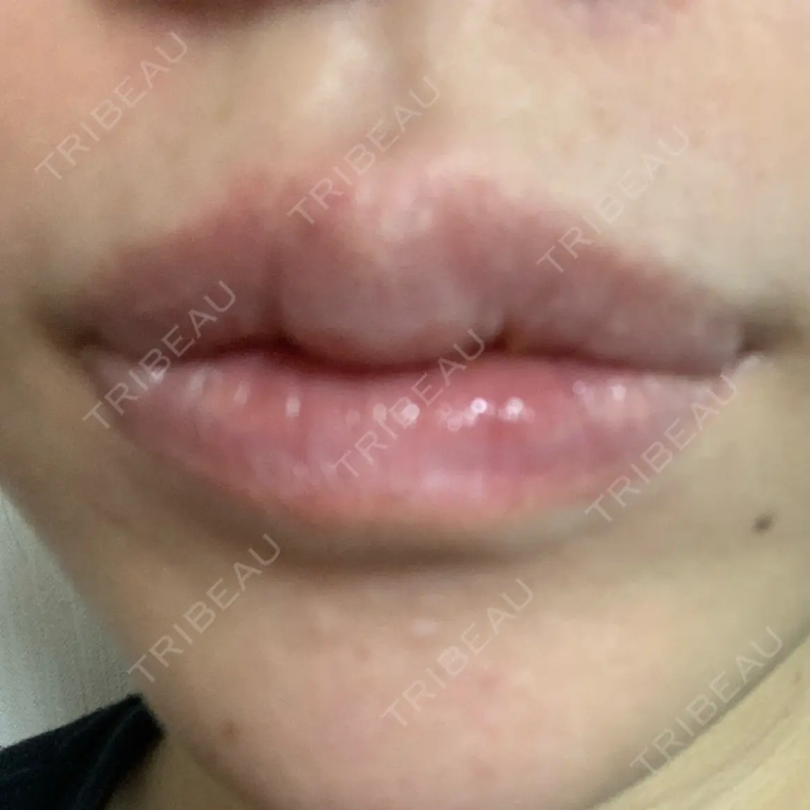 ヒアルロン酸注入（唇） PRO CLINIC プロクリニック 銀座院 AFTER