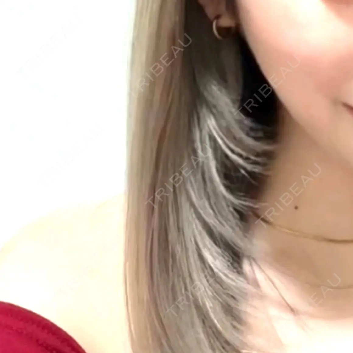 ボトックス（エラ・小顔） AYANAフィラーズクリニック 渋谷院 AFTER
