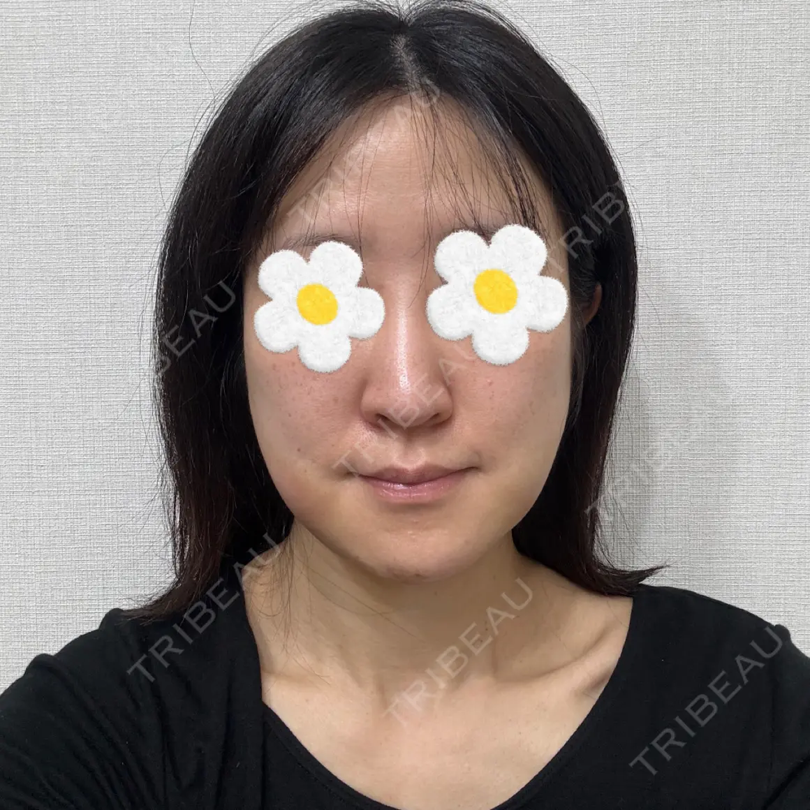 糸リフト / バッカルファット除去 / 脂肪吸引（顔） ICON CLINIC DAY 1