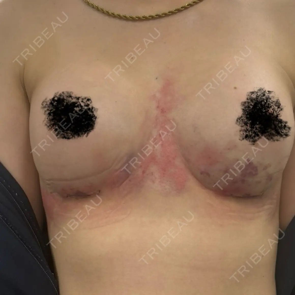 豊胸（シリコンバッグ） Lipo Clinic omotesando DAY 8