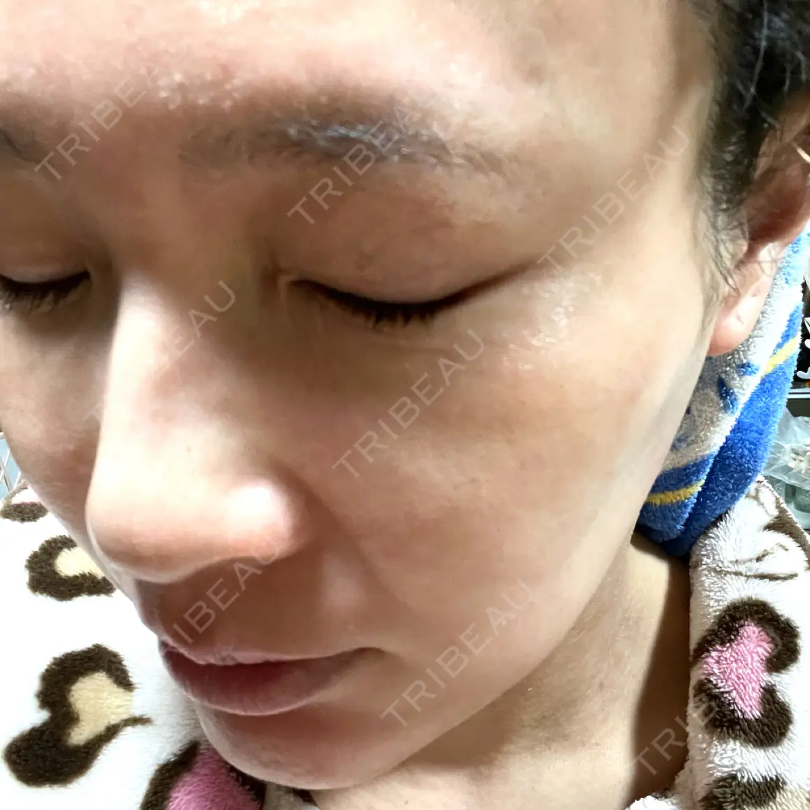 ダーマペン TCB東京中央美容外科 金山院 AFTER