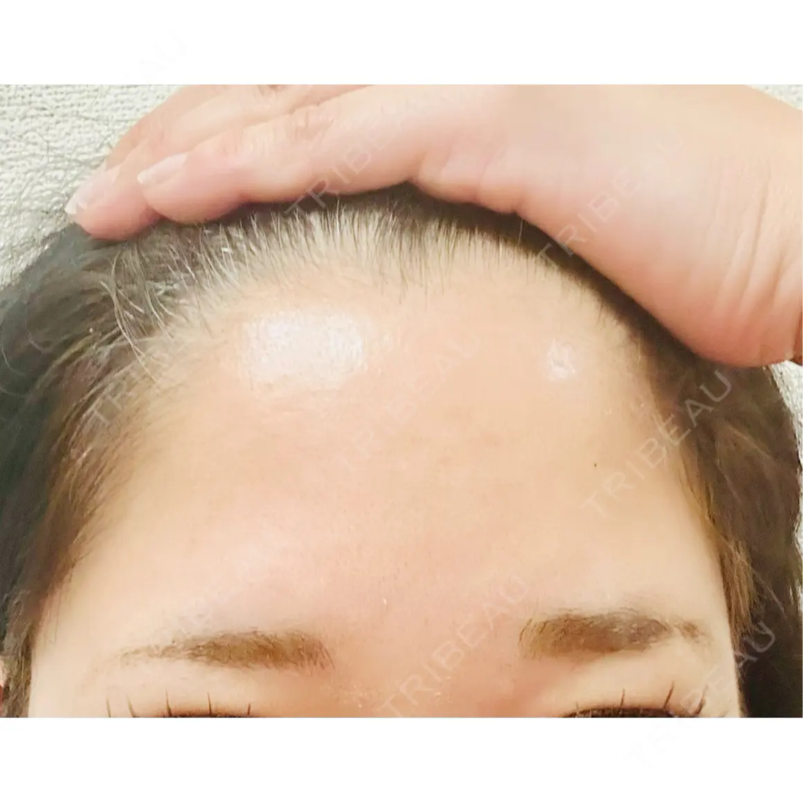 ボトックス（エラ・小顔） / ボトックス（タレ目） / ボトックス（肩） / ボトックス（眉間） / ボトックス（額） / ボトックス（ガミースマイル） / その他（目元） / その他（鼻） メディカルアルファクリニック AFTER