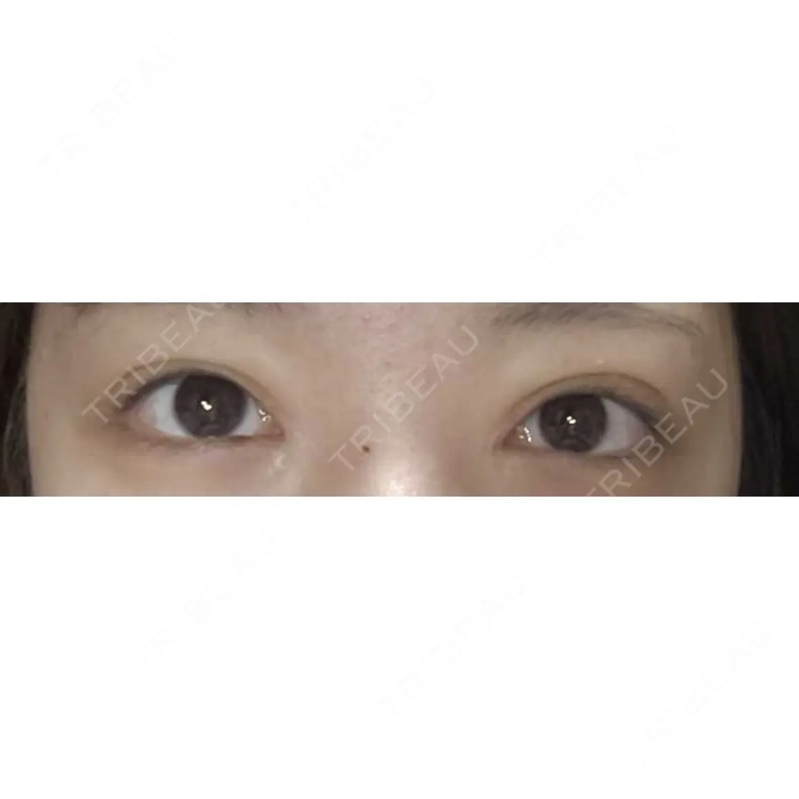 眼瞼下垂（切開） / ボトックス（額） Otus Clinic 【オータスクリニック】 AFTER