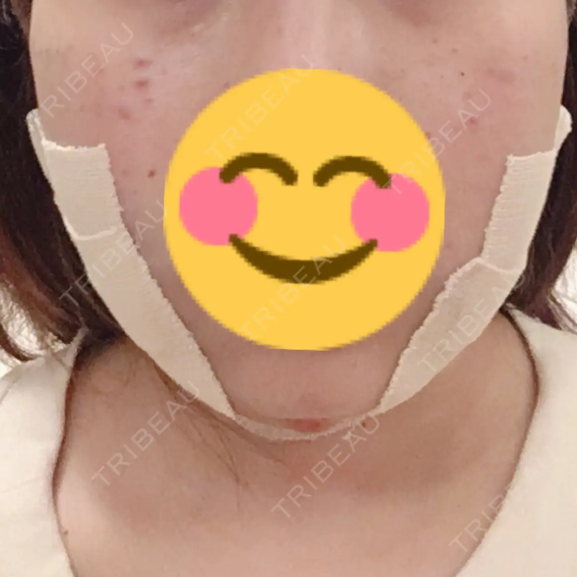 バッカルファット除去 / 脂肪吸引（顔） / 水光注射（ハリ・美肌） / ボトックス（エラ・小顔） エートップ美容整形外科 DAY 0