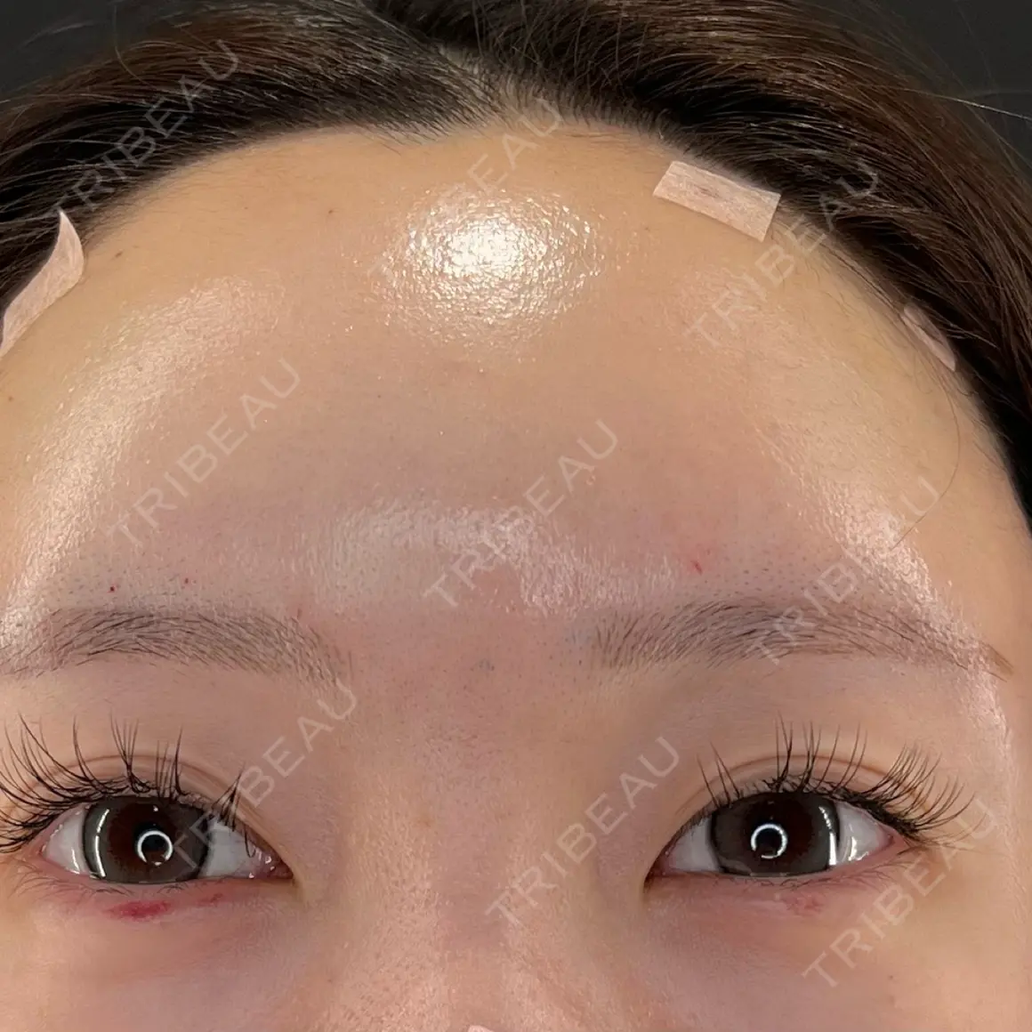 脂肪注入（額） HAAB×DREAM BEAUTY CLINIC 大阪梅田院 DAY 0
