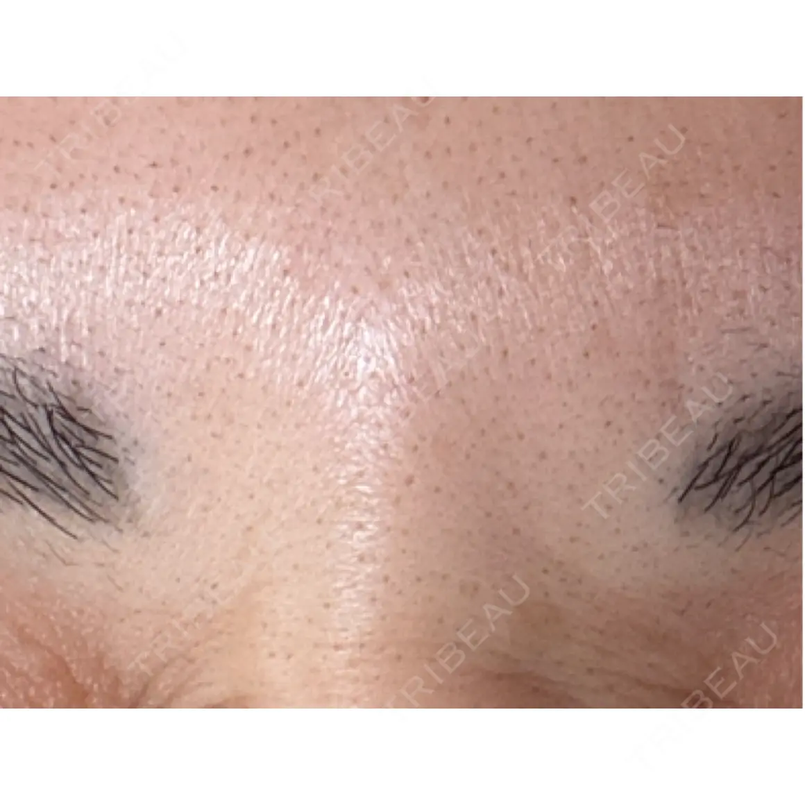 ボトックス（眉間） Leap beauty clinic AFTER