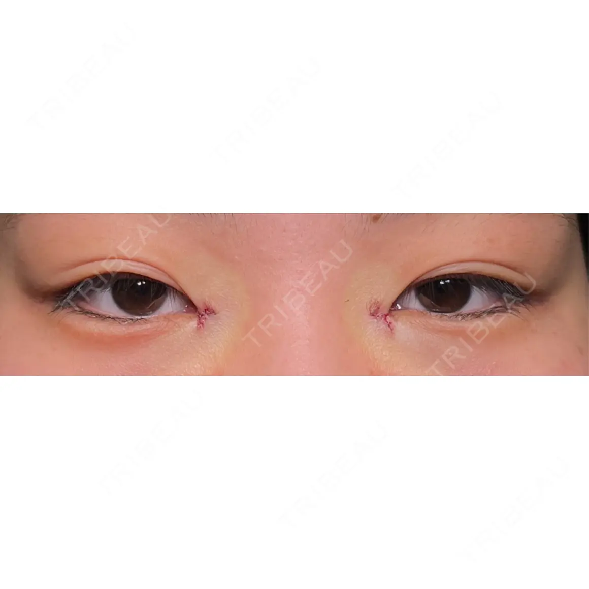 目頭切開 HAAB×DREAM BEAUTY CLINIC 大阪梅田院 DAY 13