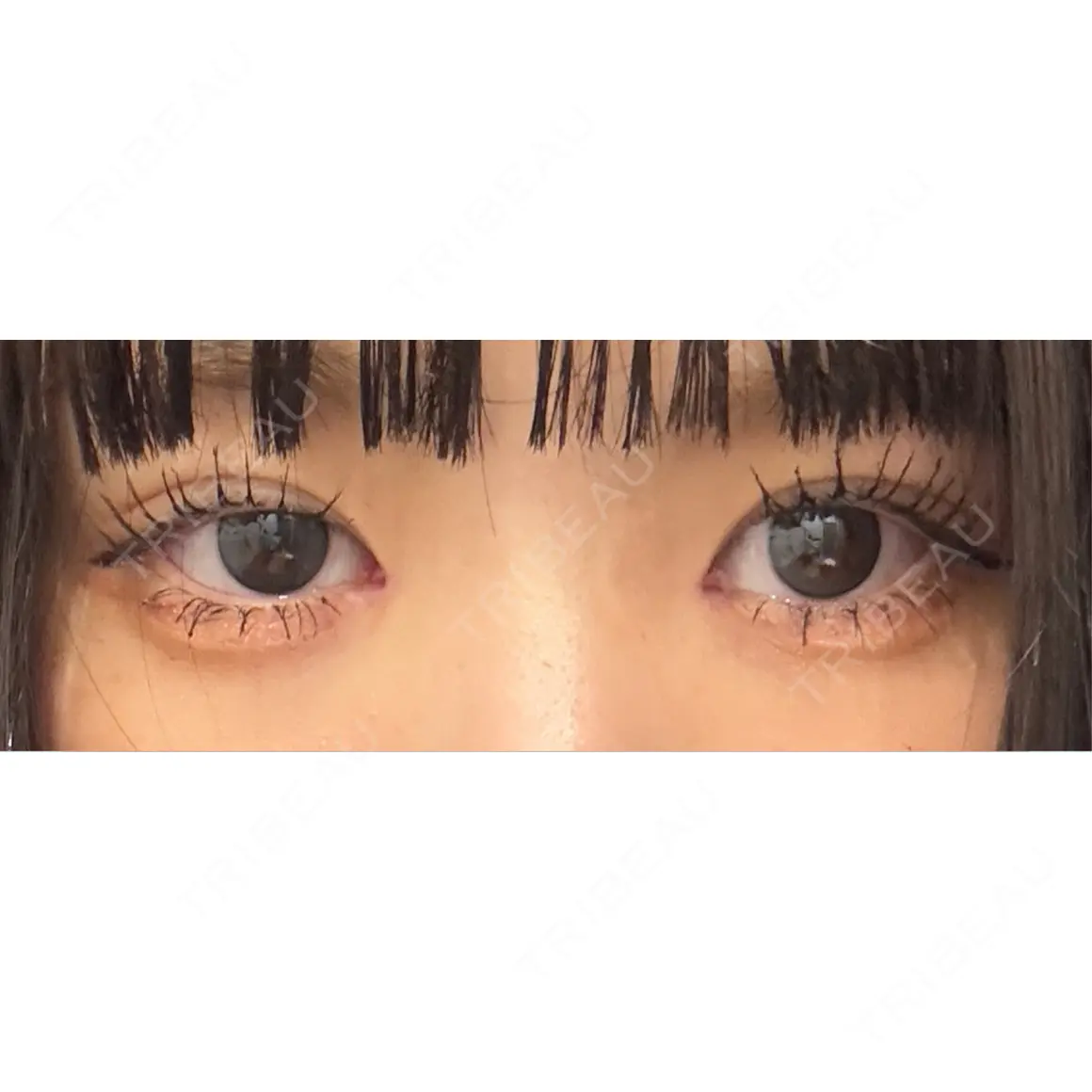 目頭切開 9BeautyClinic AFTER