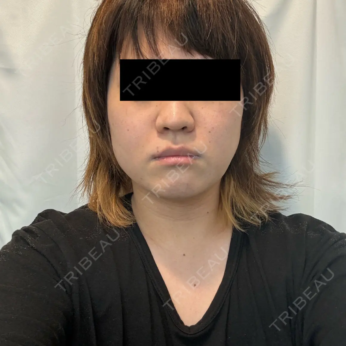 脂肪吸引（顔） / ボトックス（エラ・小顔） Mods Clinic（モッズクリニック） 東京院 DAY 37