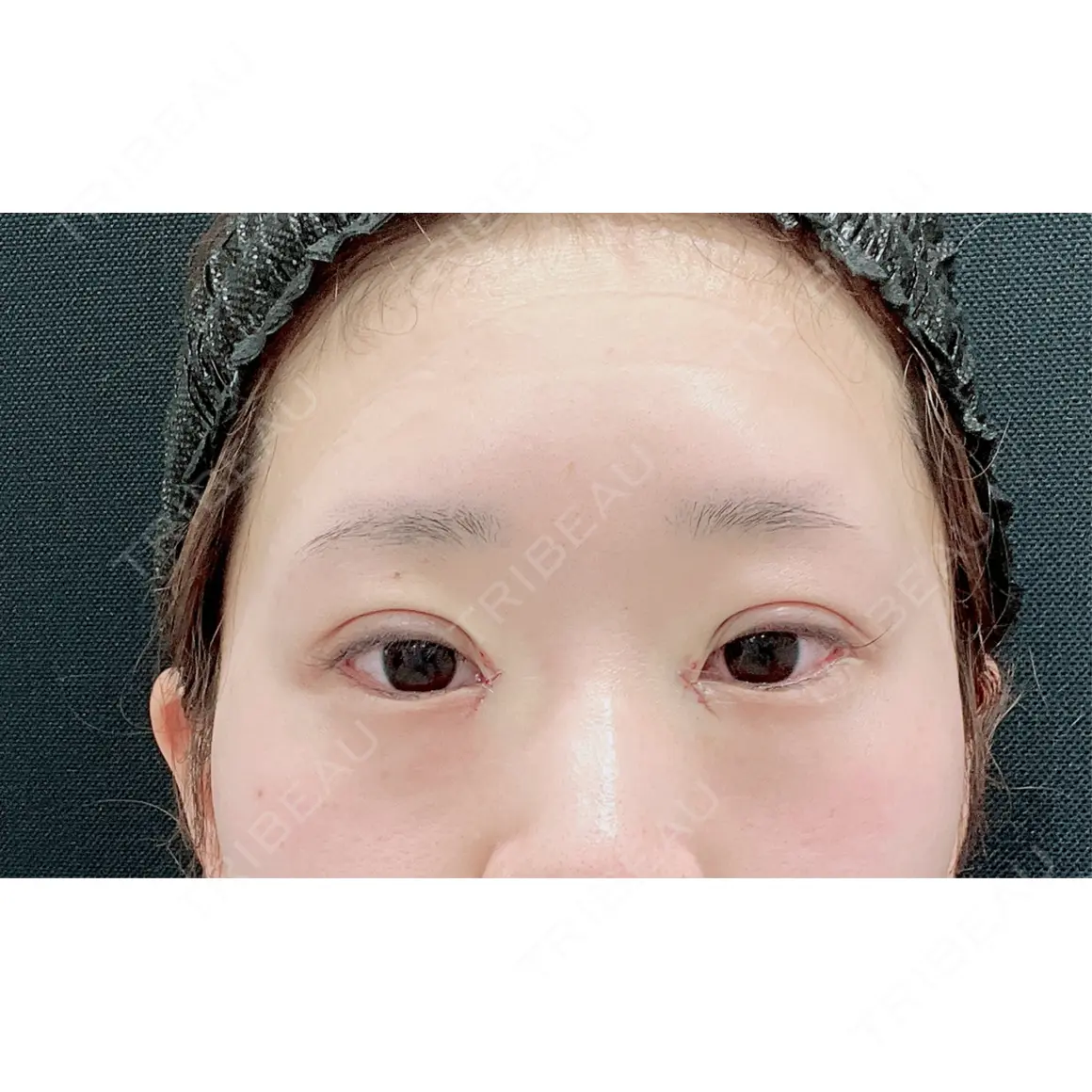 二重埋没 / 目頭切開 東京シンデレラ美容外科 池袋院 DAY 6
