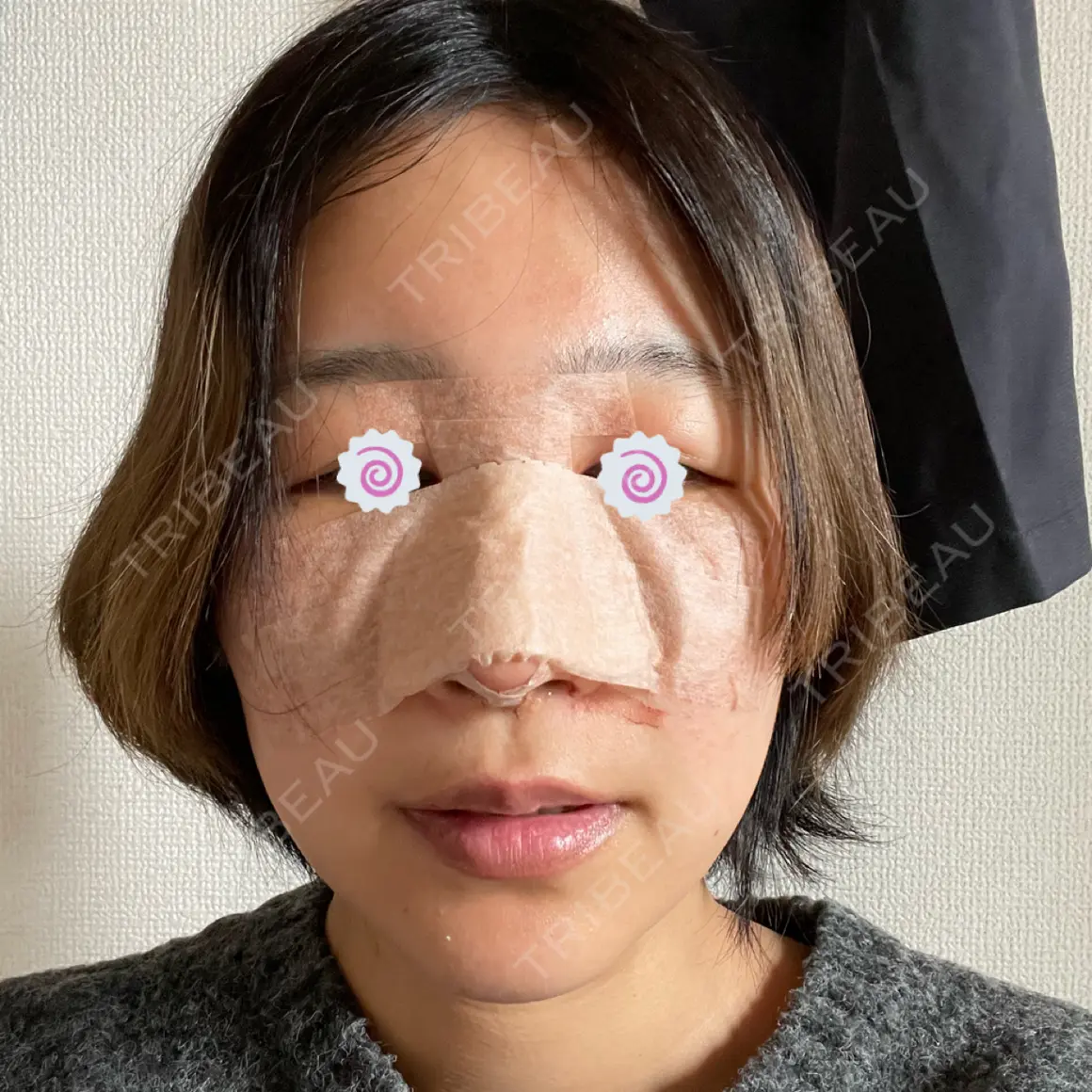 隆鼻術 / 鼻中隔延長（切開） / 軟骨移植 4Dクリニック DAY 1