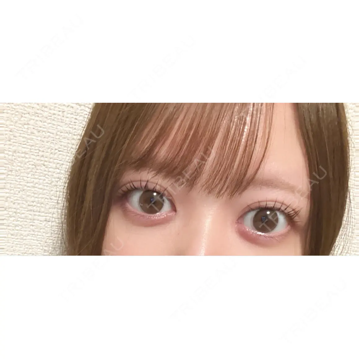 二重埋没 / 目頭切開 / 自然癒着法 Brandnew Beauty Clinic AFTER