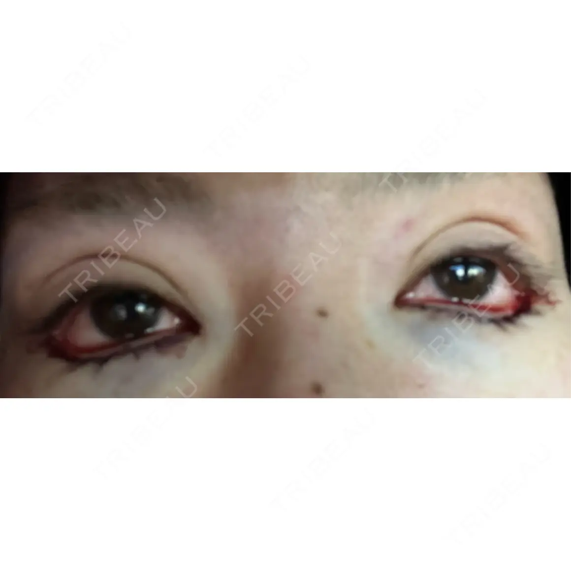 二重埋没 / 目尻切開 / 下まぶたの脂肪取り / タレ目形成・グラマラスライン（切開） / 目尻靭帯移動 エターナル美容クリニック DAY 0