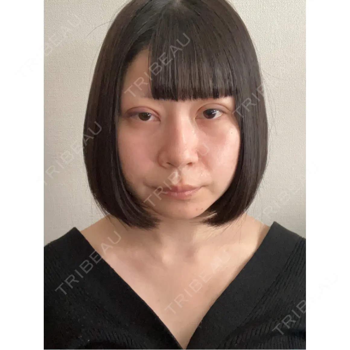 二重埋没 / 上まぶたの脂肪取り 藤・ナチュレ美容クリニック 銀座院 DAY 1