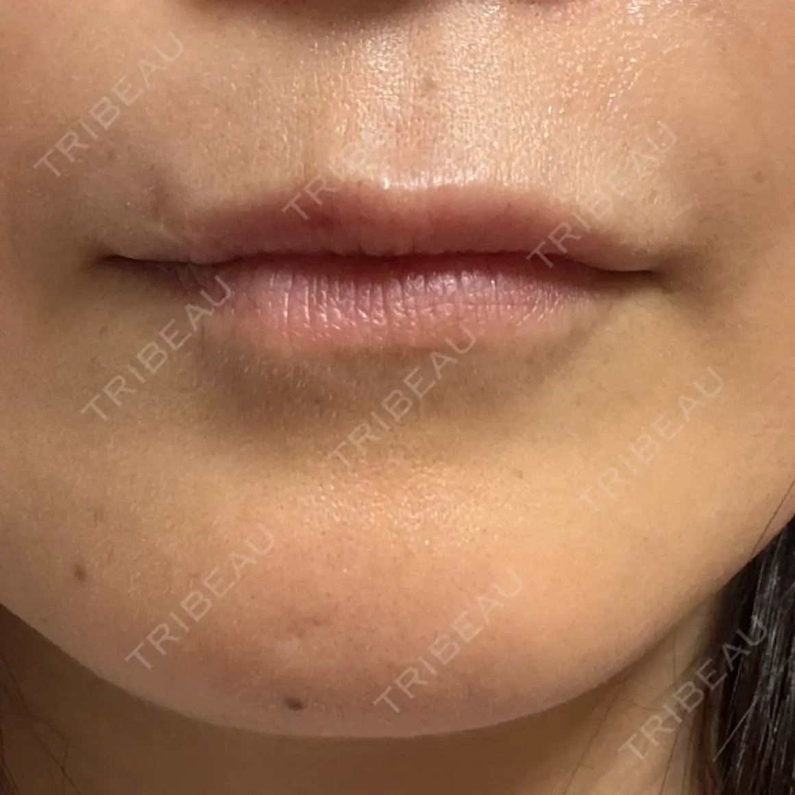 ヒアルロン酸注入（唇） PRO CLINIC プロクリニック 銀座院 AFTER
