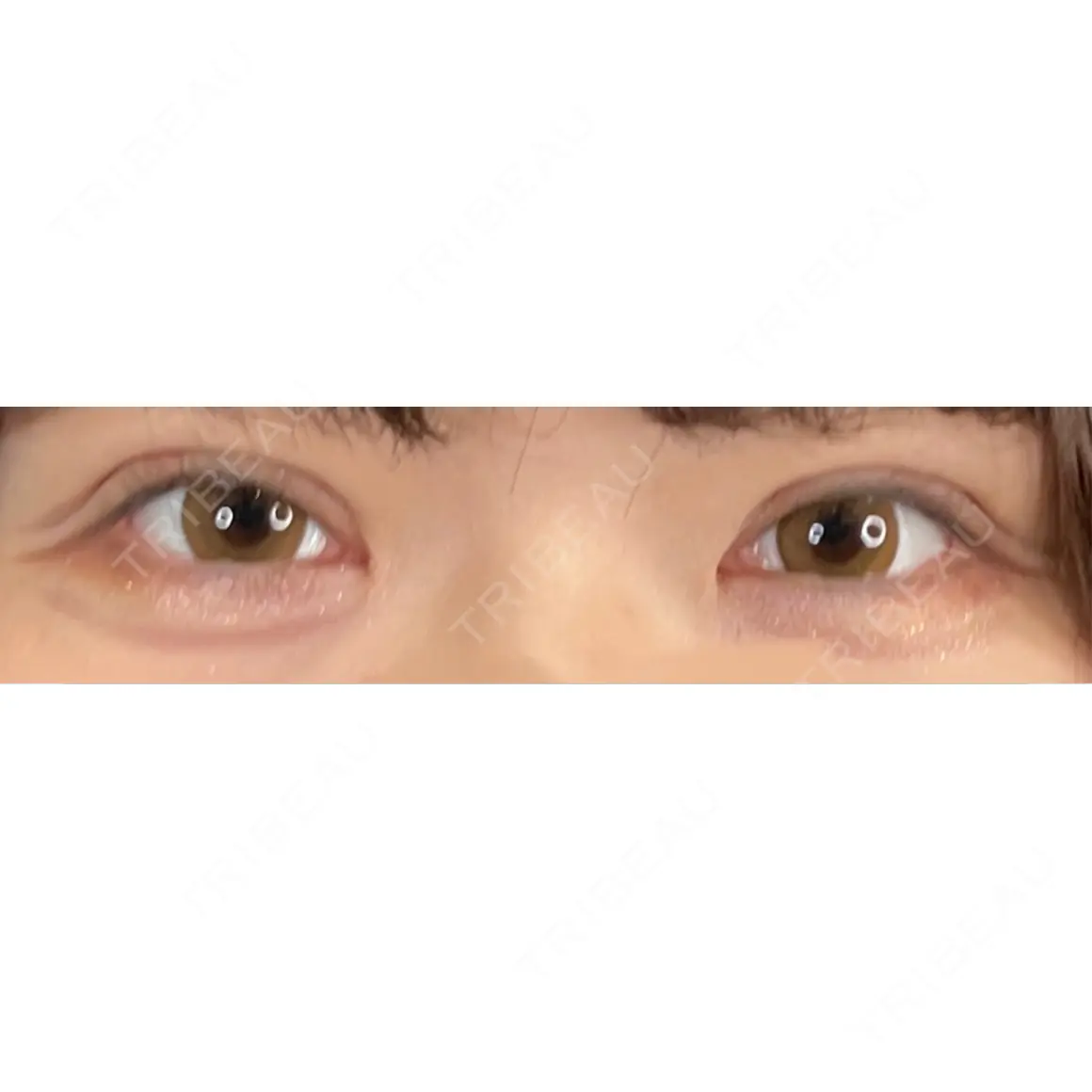 二重埋没 / 上まぶたの脂肪取り 藤・ナチュレ美容クリニック 銀座院 DAY 8