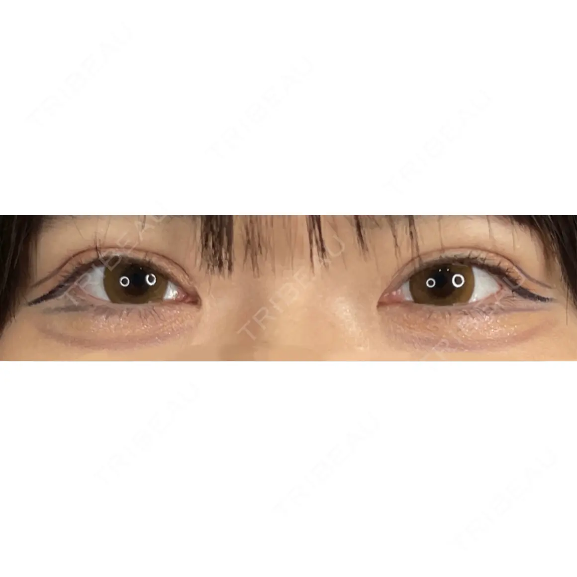 二重埋没 / 上まぶたの脂肪取り 藤・ナチュレ美容クリニック 銀座院 AFTER