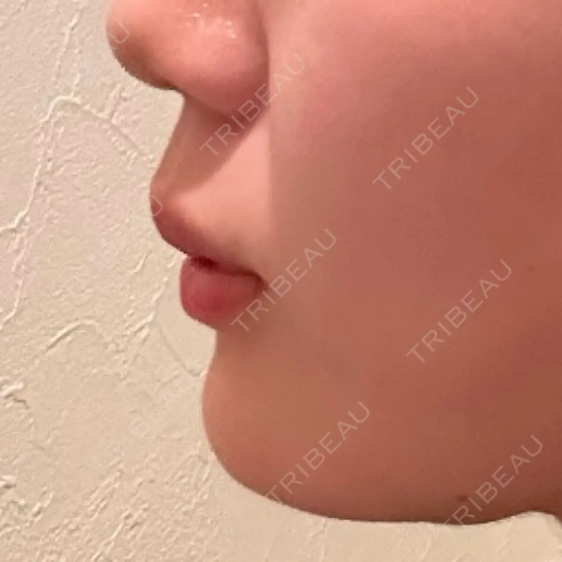 ボトックス（あご） / ヒアルロン酸注入（あご） ルラ美容クリニック 名古屋本院 DAY 0