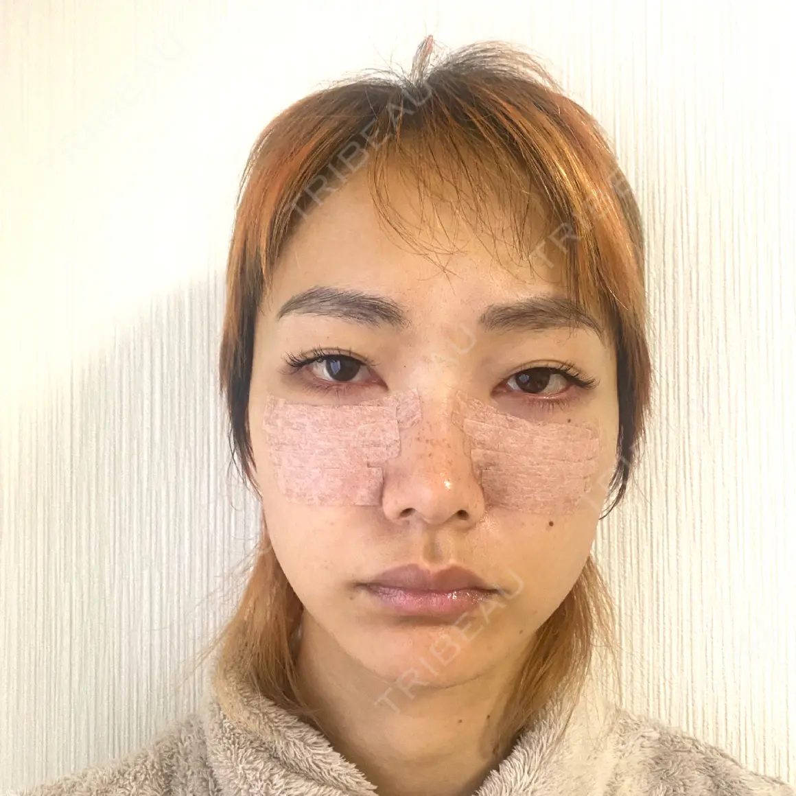 クマ治療 EMMO FACE CLINIC 東京三田院 DAY 1