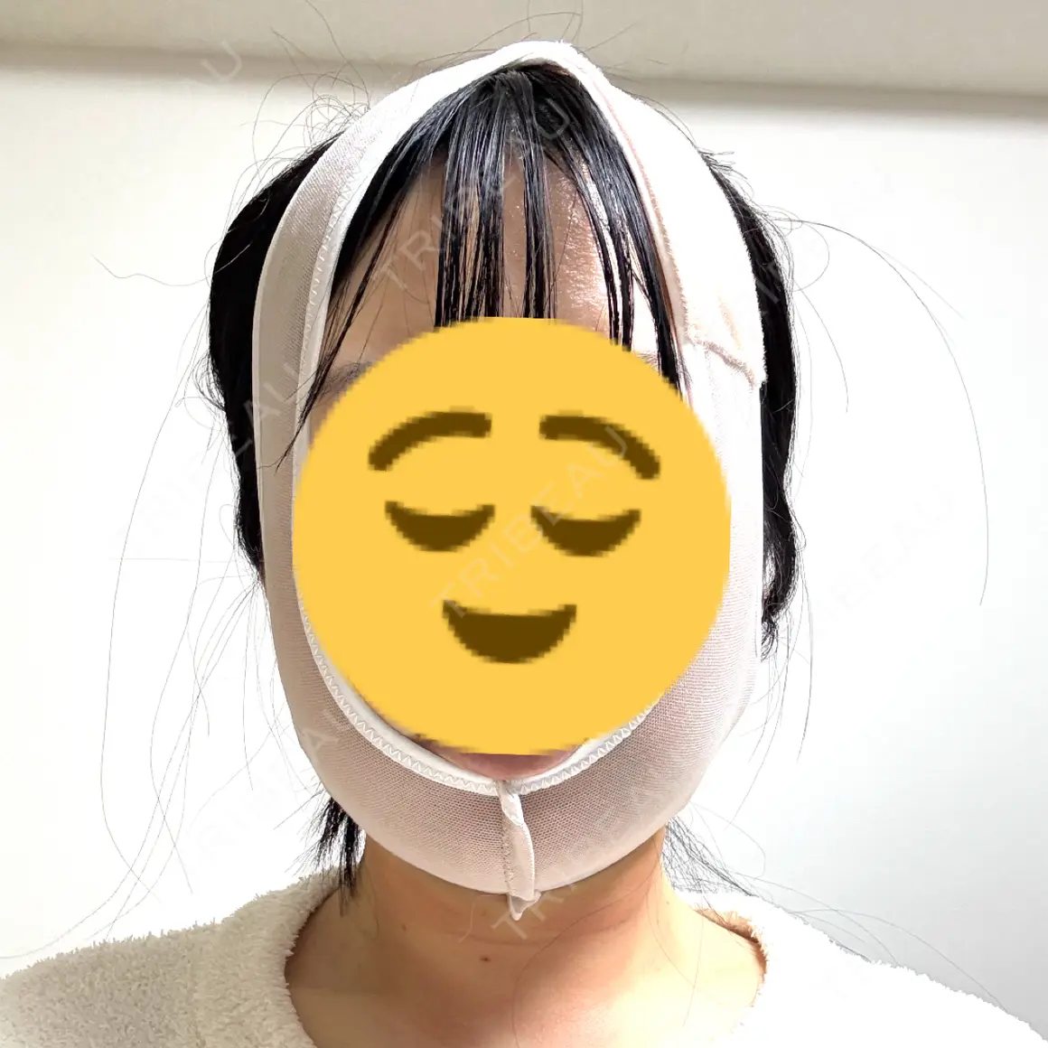 糸リフト / バッカルファット除去 / 脂肪吸引（顔） / ジョールファット除去 / ボトックス（エラ・小顔） アリエル美容クリニック 大宮院 DAY 1