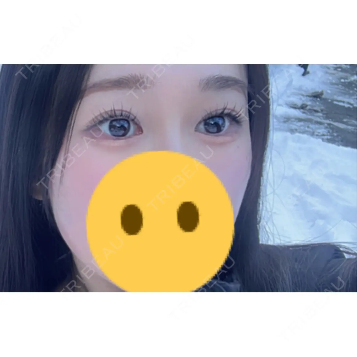 二重埋没 / 目尻切開 / その他（目元） 藤・ナチュレ美容クリニック 銀座院 AFTER