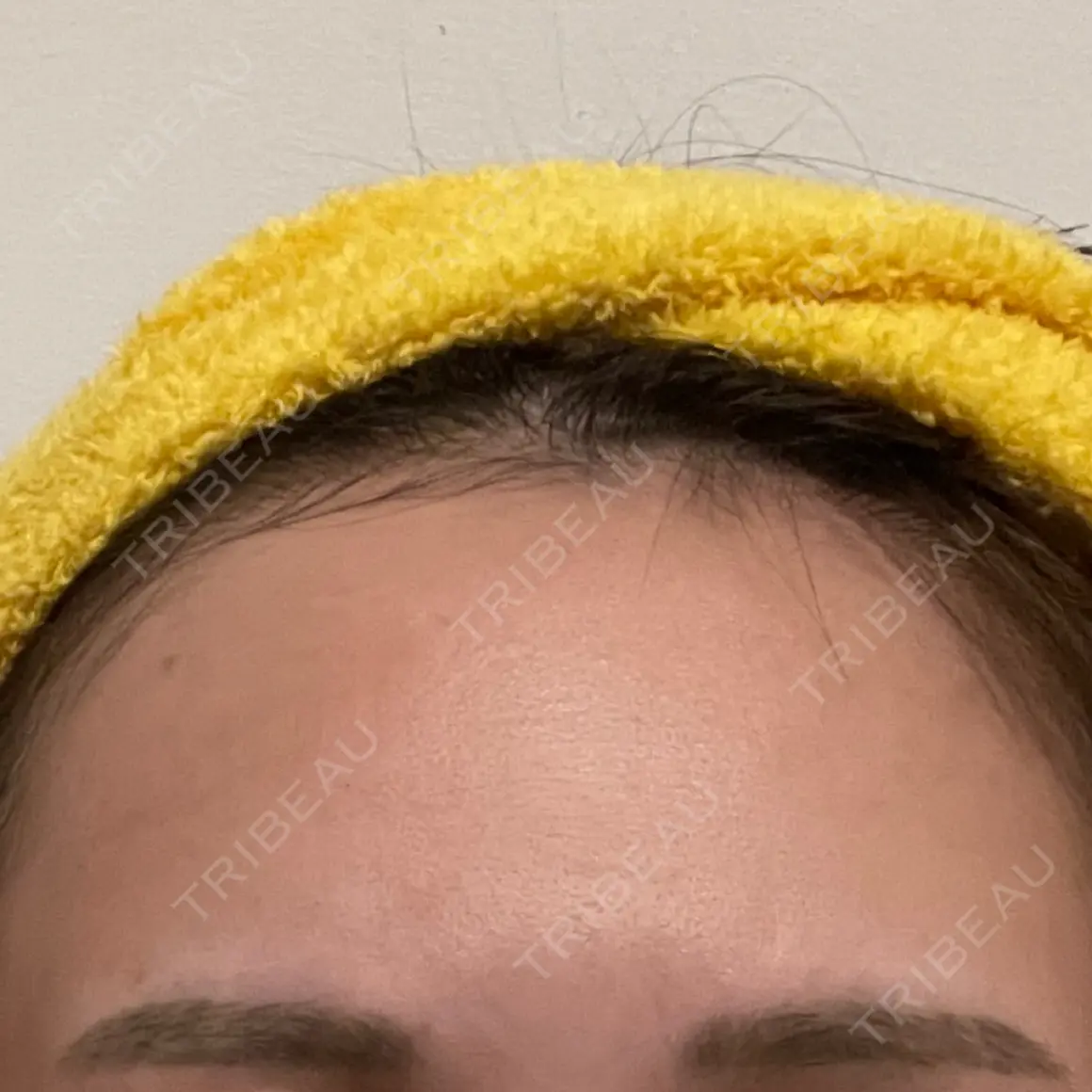 アートメイク（ヘアライン） Tokyo Tensei Clinic 新宿院 DAY 1