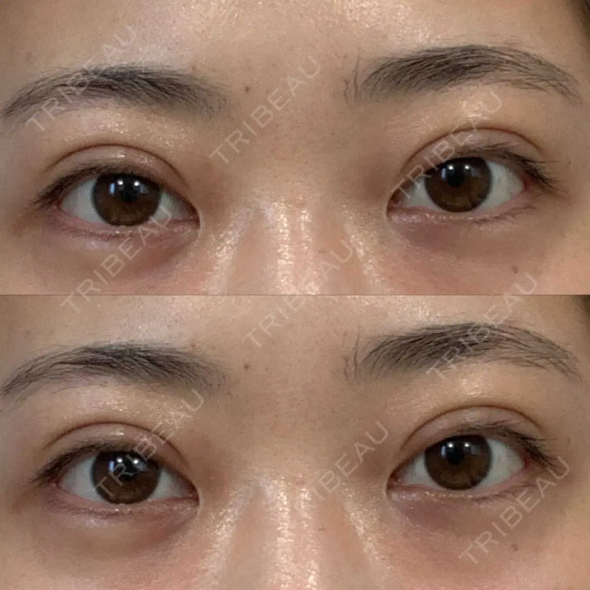 二重埋没 湘南美容クリニック 池袋東口院 AFTER