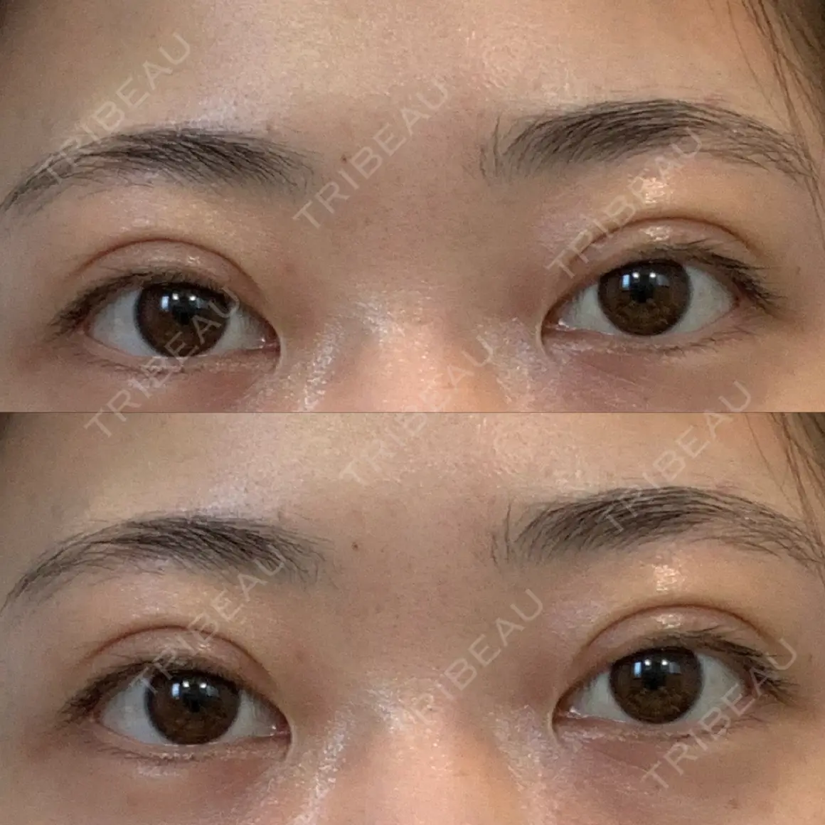二重埋没 湘南美容クリニック 池袋東口院 AFTER