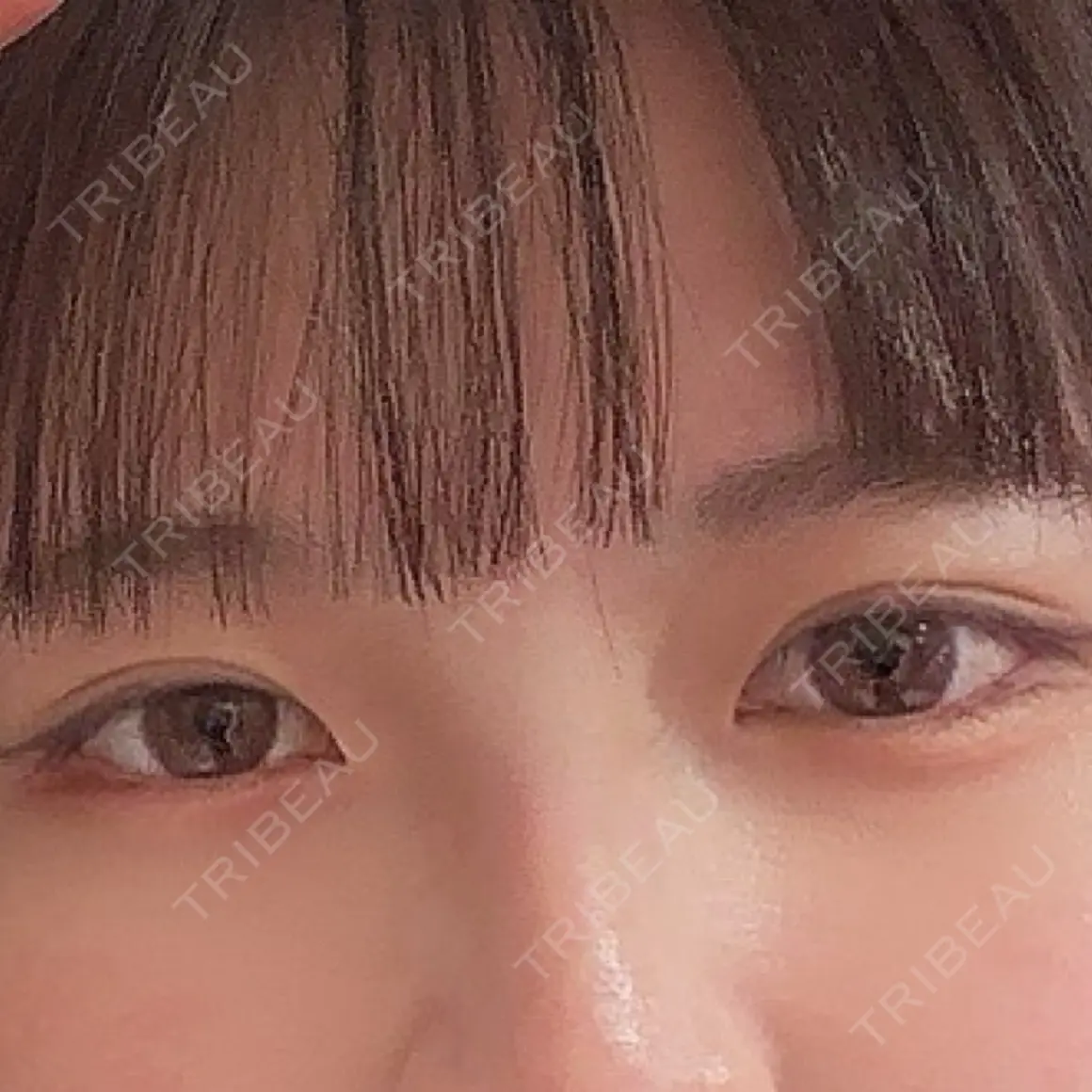 二重埋没 / 上まぶたの脂肪取り / 下まぶたの脂肪取り 東京形成美容外科 船橋院 AFTER