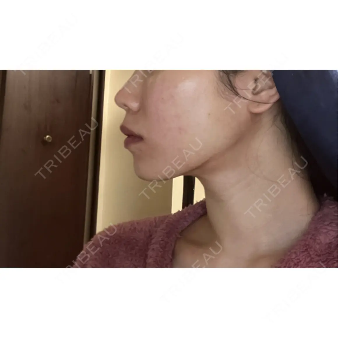 RF（高周波）たるみ治療 TUNE CLINIC【チューンクリニック】 AFTER
