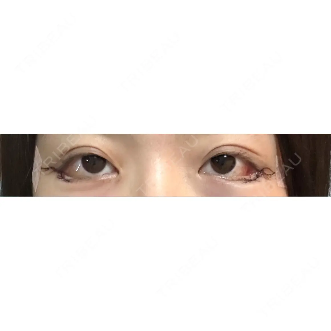 目尻切開 / タレ目形成・グラマラスライン（切開） HAAB×DREAM BEAUTY CLINIC 大阪梅田院 DAY 0