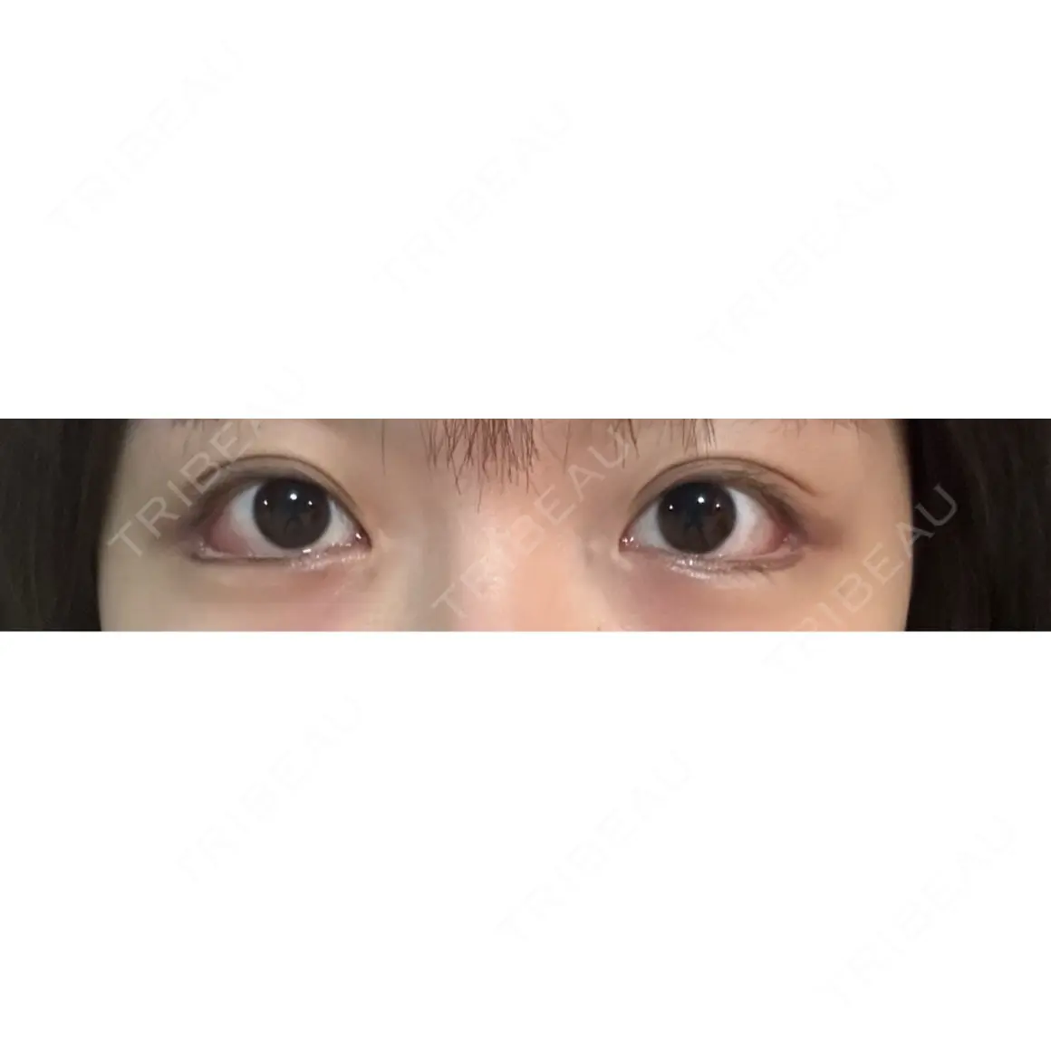 目尻切開 / タレ目形成・グラマラスライン（切開） HAAB×DREAM BEAUTY CLINIC 大阪梅田院 AFTER