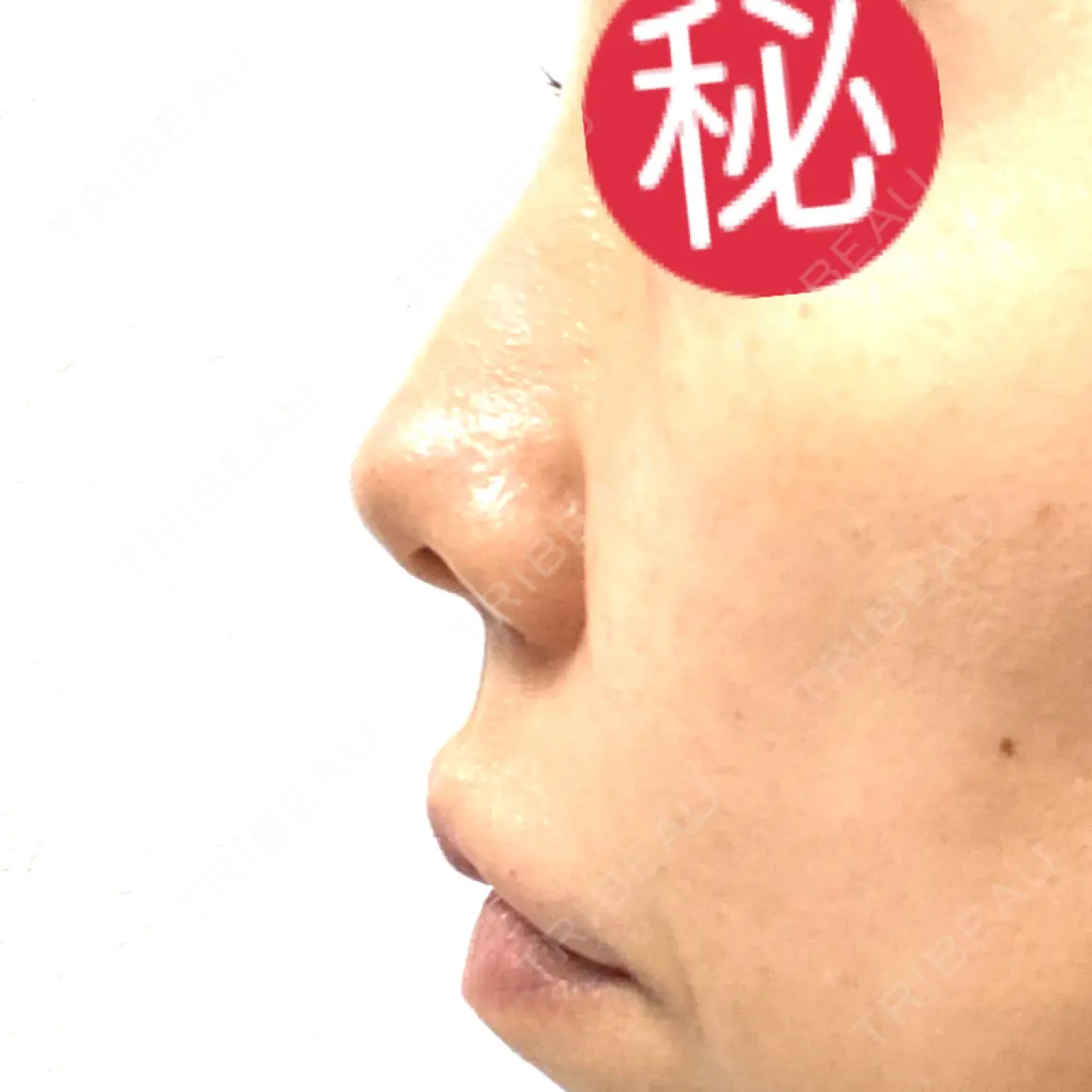 ヒアルロン酸注入（鼻） / ヒアルロン酸注入（唇） / ボトックス（目尻） HAAB×DREAM BEAUTY CLINIC 大阪梅田院 DAY 1