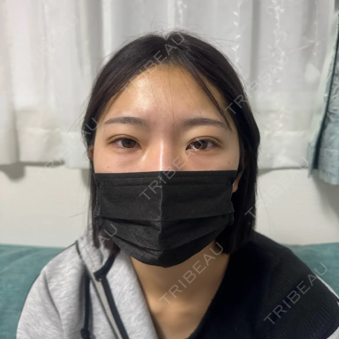 二重埋没 湘南美容クリニック 千葉センシティ院 DAY 0
