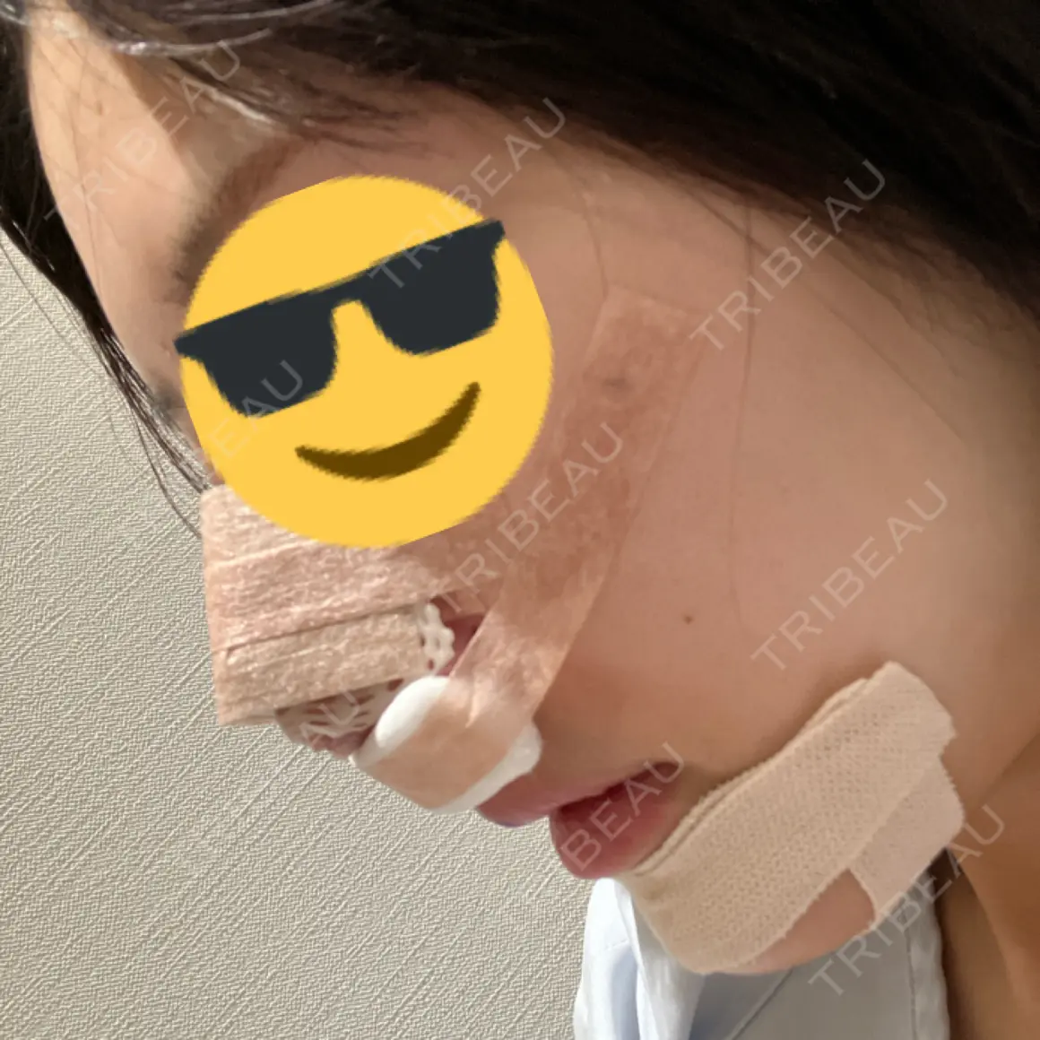 鼻尖形成（切開） / 小鼻縮小（切開） / 軟骨移植 / 骨切幅寄せ ザ・プラス美容外科 DAY 0