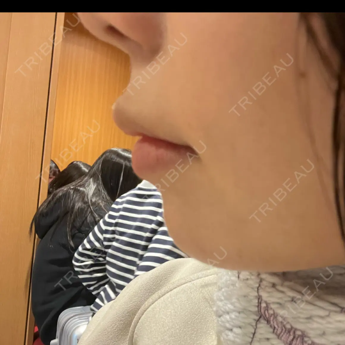 人中短縮 ルラ美容クリニック 東京駅前院 DAY 0