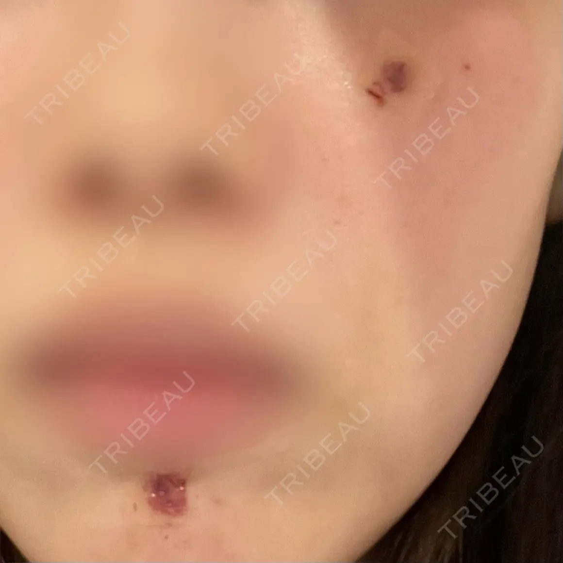 ほくろ・いぼ除去レーザー（肌） Mavie Beauty Clinic （マヴィービューティークリニック） DAY 0