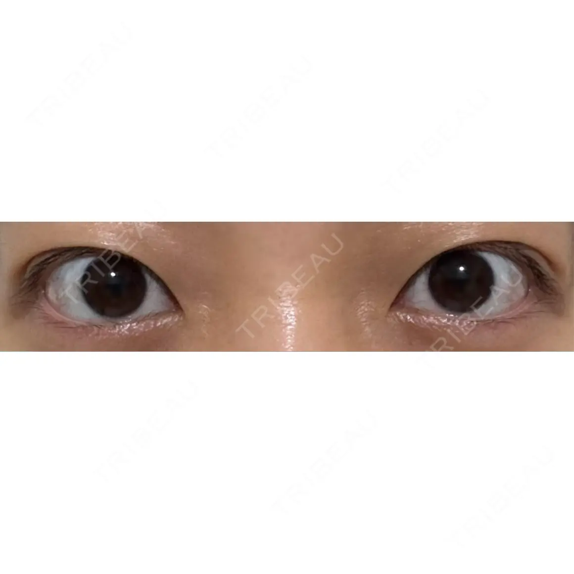 二重埋没 オアシス美容外科 AFTER