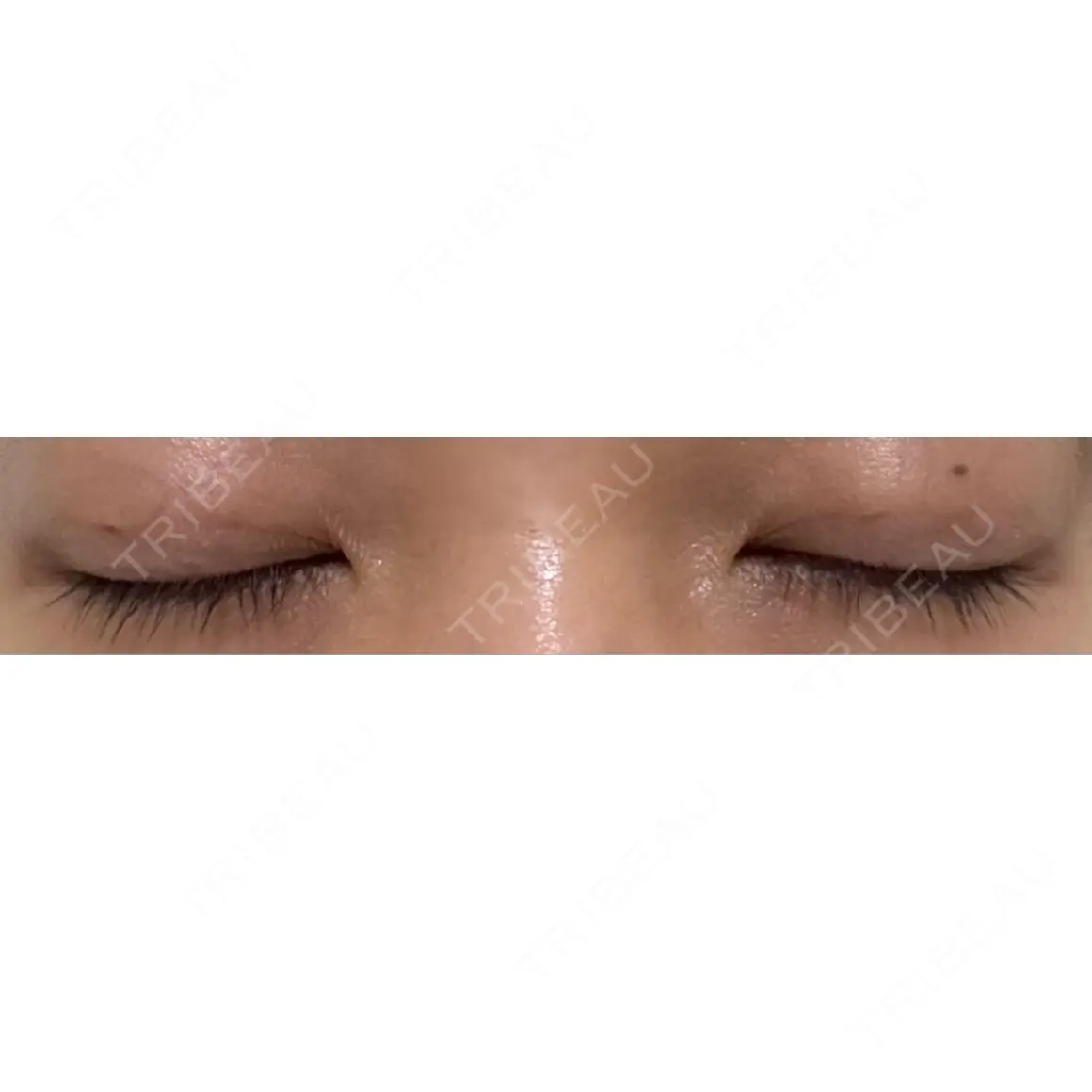 二重埋没 オアシス美容外科 AFTER