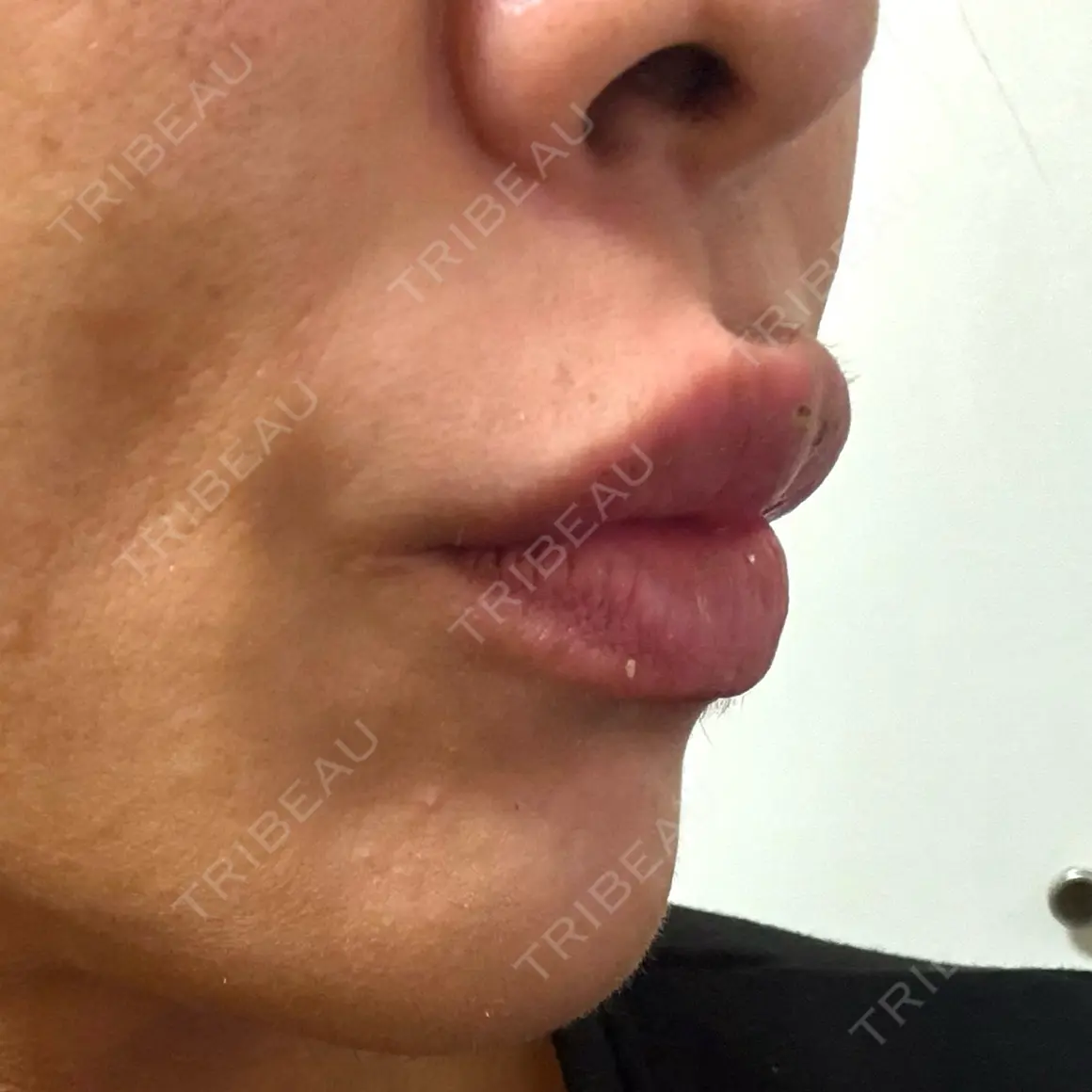 ヒアルロン酸注入（あご） / ヒアルロン酸注入（唇） PRO CLINIC プロクリニック 銀座院 AFTER