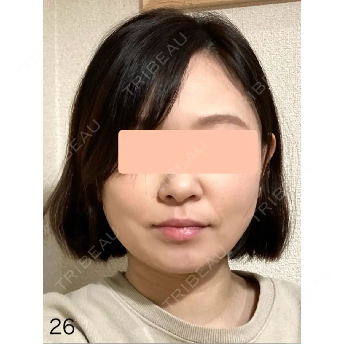 糸リフト / 脂肪吸引（顔） 脂肪吸引ラボトウキョウ AFTER