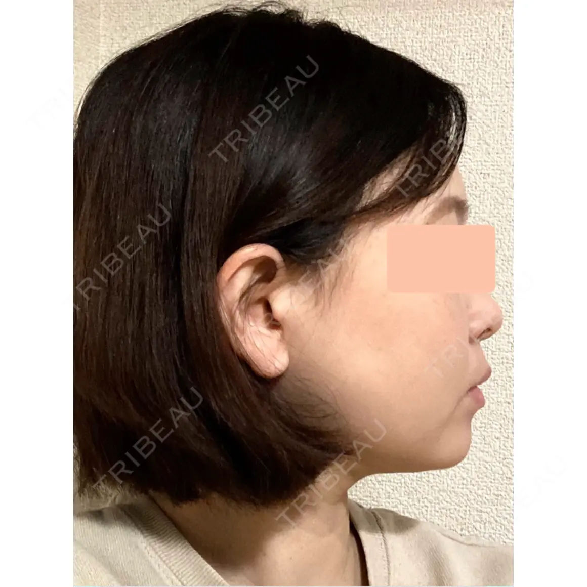 糸リフト / 脂肪吸引（顔） 脂肪吸引ラボトウキョウ AFTER